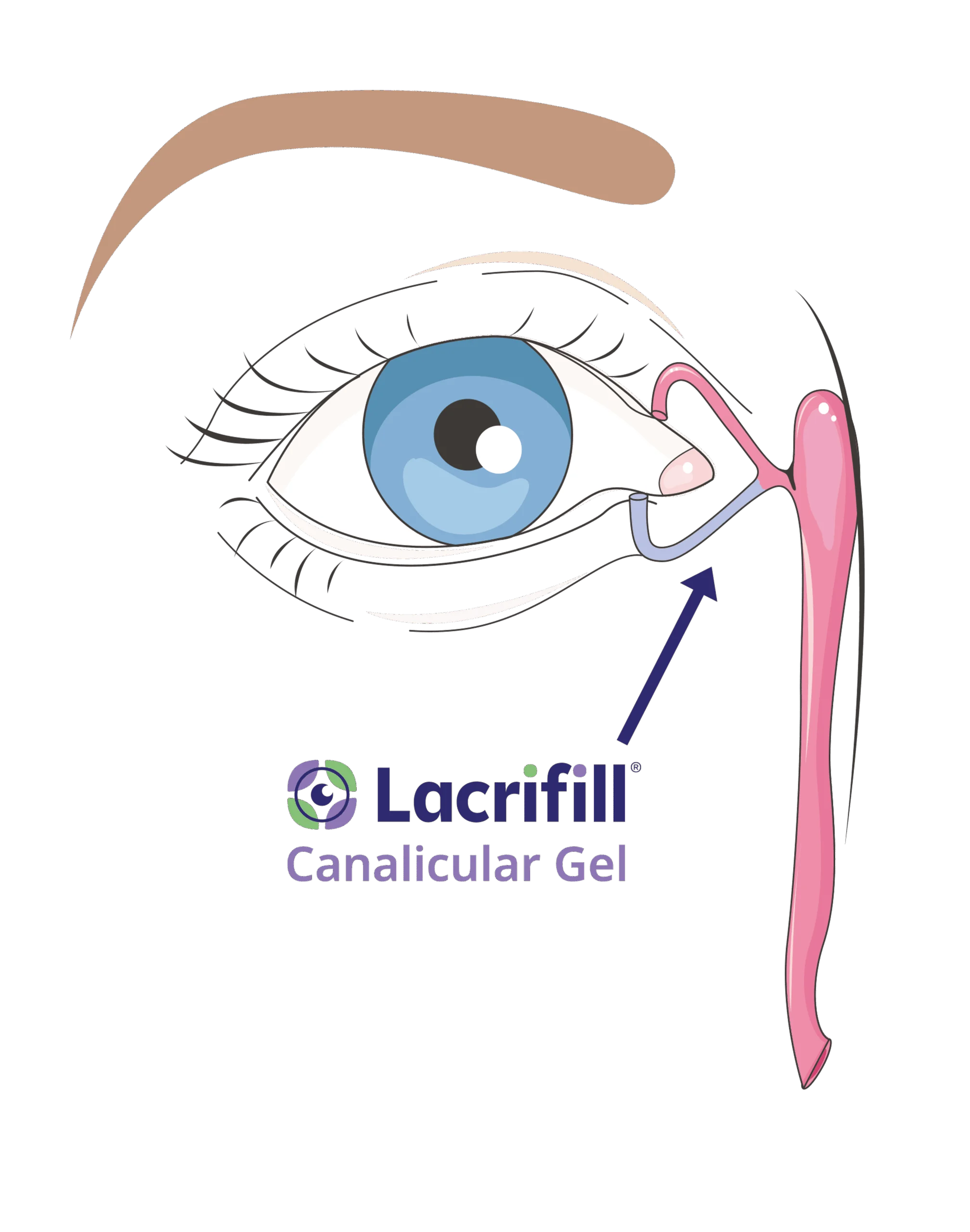 Lacrifill explainer diagram transaprent scaled | Lacrifill